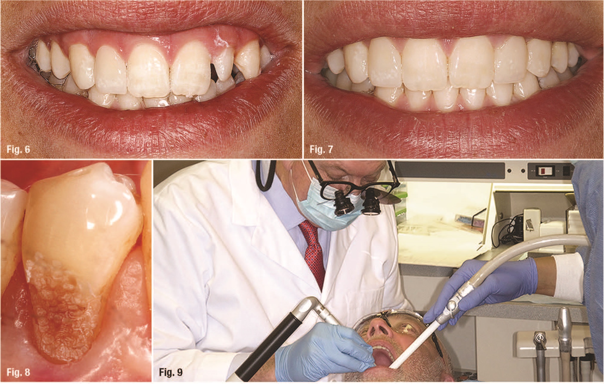 Creating Natural-looking Composite Restorations