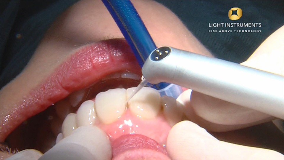 <strong>Caries tissue ablation with LiteTouch™ Er:YAG laser</strong>