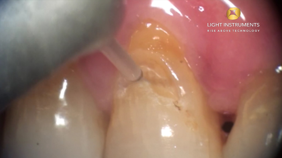 <strong>Class 5 Cavity Preparation II with LiteTouch™ Er:YAG laser</strong>