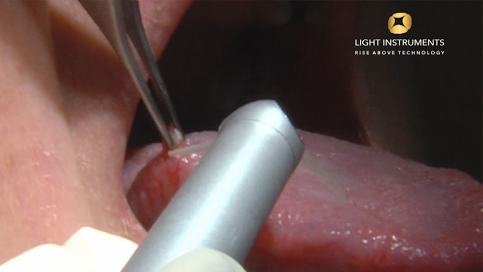 <strong> Fibroma removal with LiteTouch™ Er:YAG laser </strong>