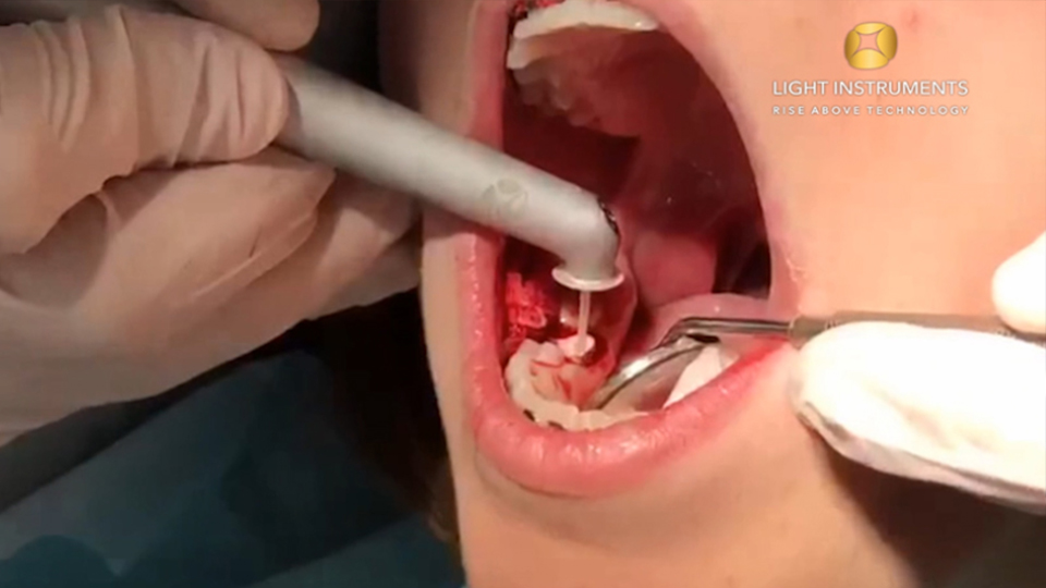 <strong>Gingivectomy during Orthodontic treatment with LiteTouch™ Er:YAG laser</strong>
