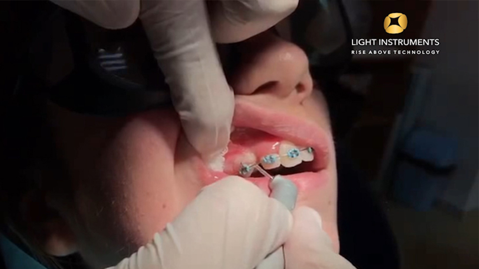 <strong>Gingivectomy with LiteTouch™ Er:YAG laser</strong>
