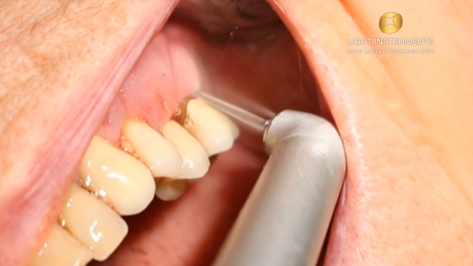 <strong>Periodontal pocket treatment with LiteTouch™ Er:YAG laser</strong>