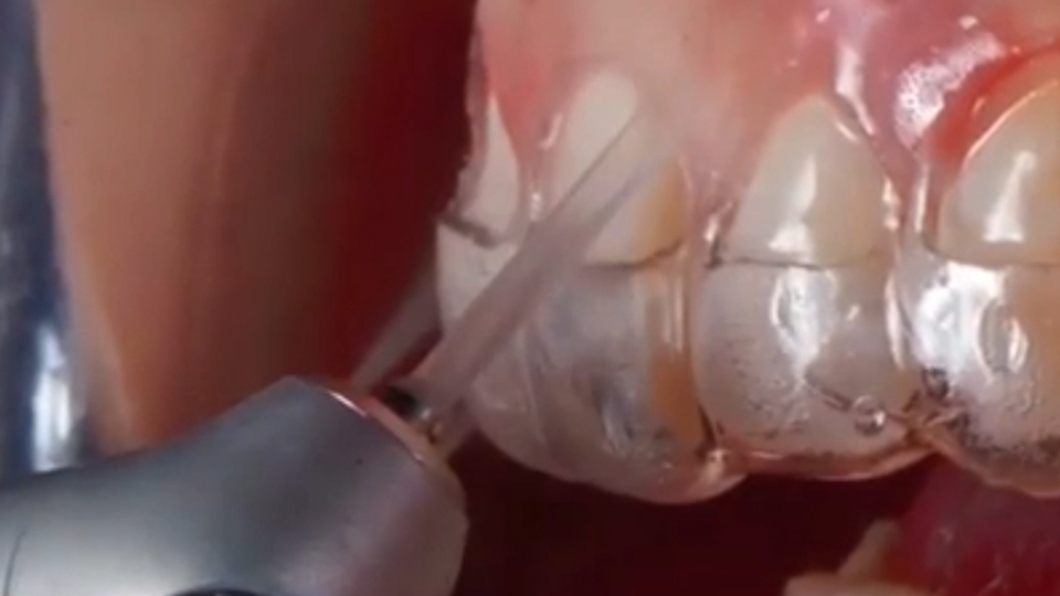 <strong>Surgical crown lengthening with LiteTouch™ Er:YAG laser</strong>