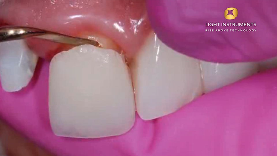 <strong>Veneer removal with LiteTouch™ Er:YAG laser</strong>