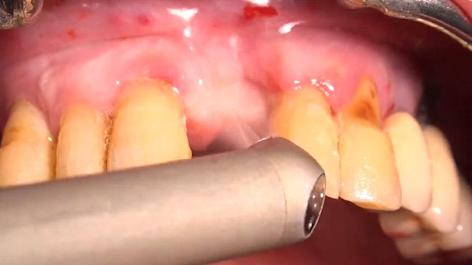 <strong>Zirconia implants with LiteTouch™ Er:YAG laser</strong>