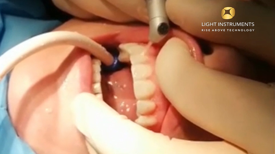 <strong>Gingivectomy II with LiteTouch™ Er-YAG laser</strong>
