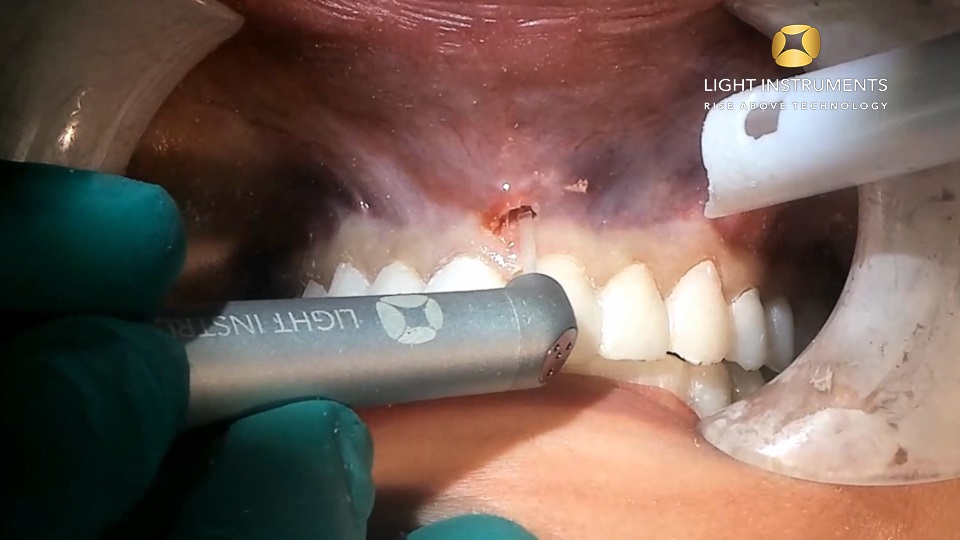 <strong>Maxillary frenectomy with LiteTouch™ Er:YAG laser</strong>