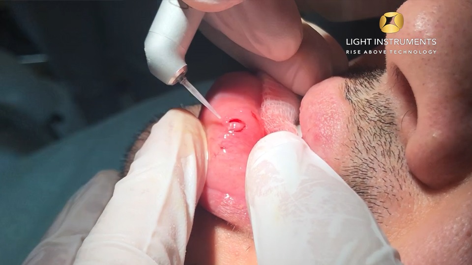 <strong>Mucocele removal with LiteTouch™ Er:YAG laser</strong>