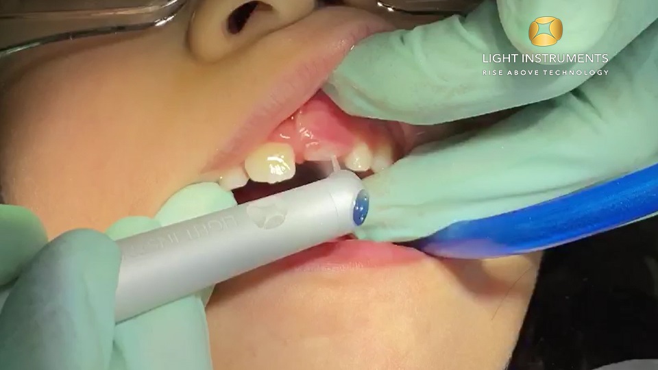 <strong>Uncovering of unerupted incisor with LiteTouch™ Er:YAG laser</strong>