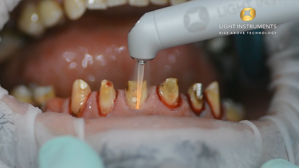 <strong>Gingival reconstruction and disinfection with LiteTouch™ Er:YAG laser</strong>