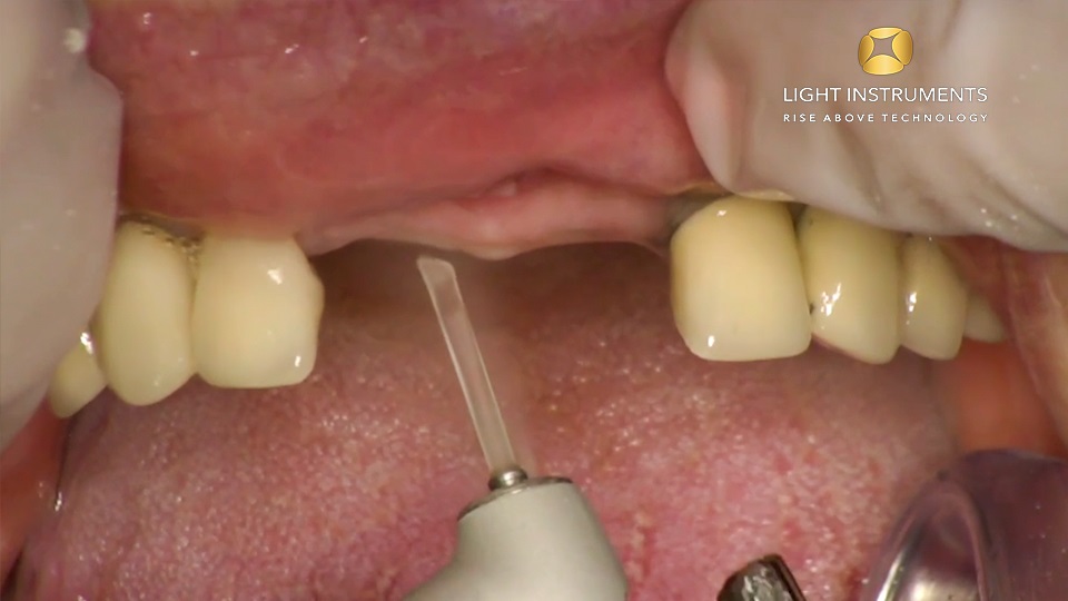 <strong> Implant exposure with LiteTouch™ Er:YAG laser</strong>