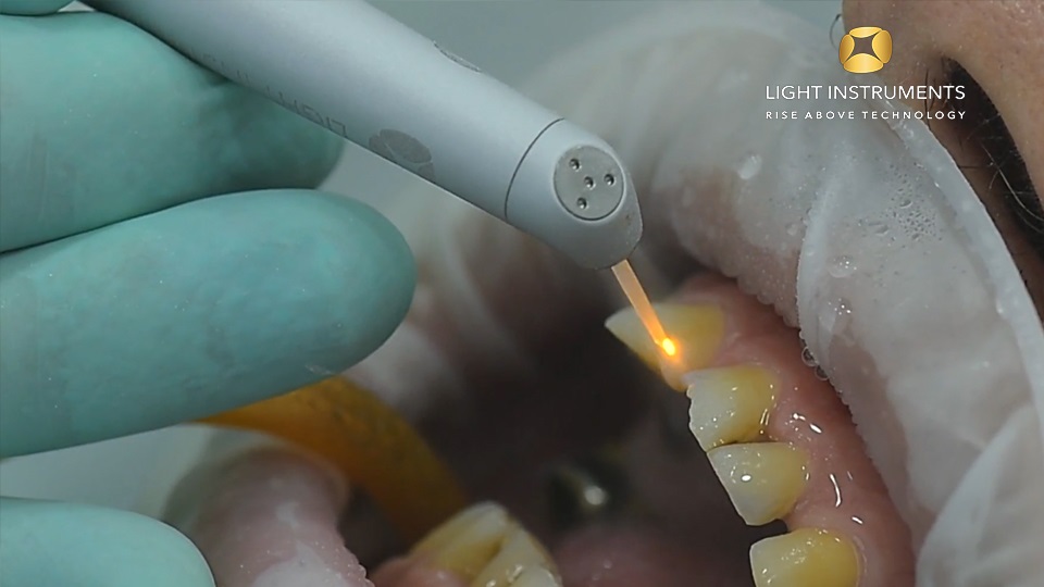 <strong>Laser conditioning of tooth for bonding with LiteTouch™ Er:YAG laser</strong>