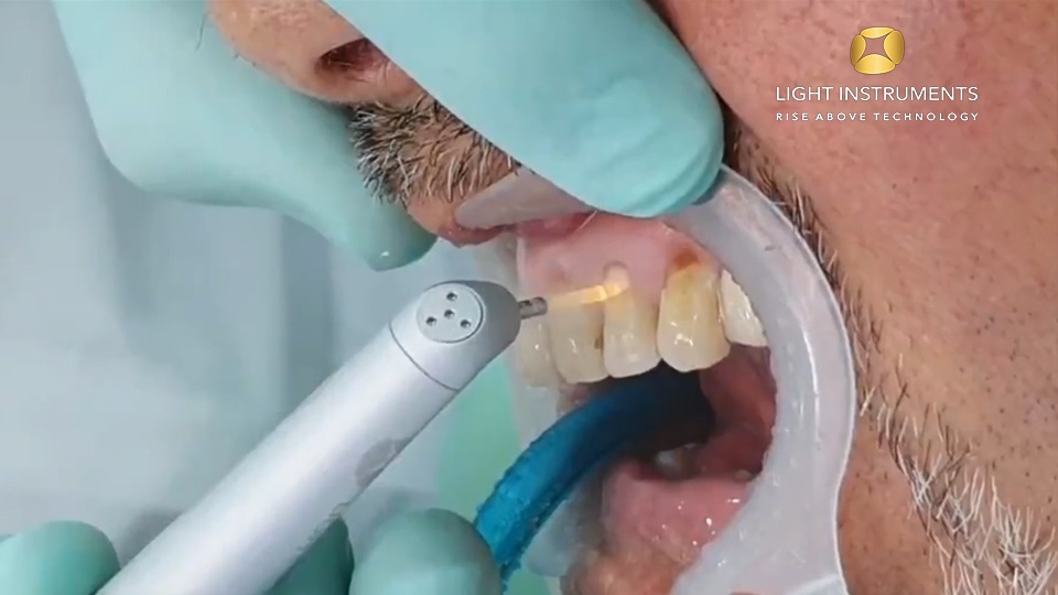<strong>Laser conditioning of tooth for bonding II with LiteTouch™ Er:YAG laser</strong>