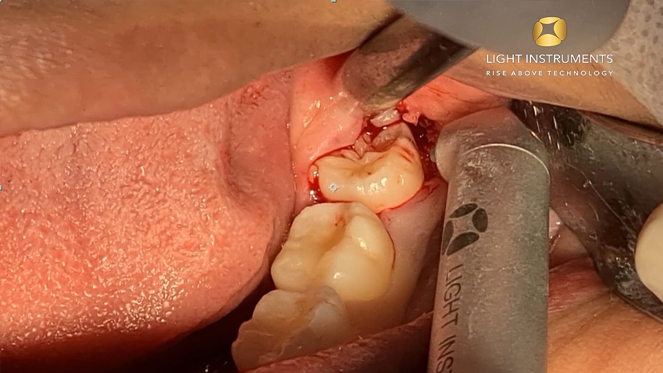 <strong>3rd Molar Surgery with LiteTouch™ Er:YAG laser</strong>