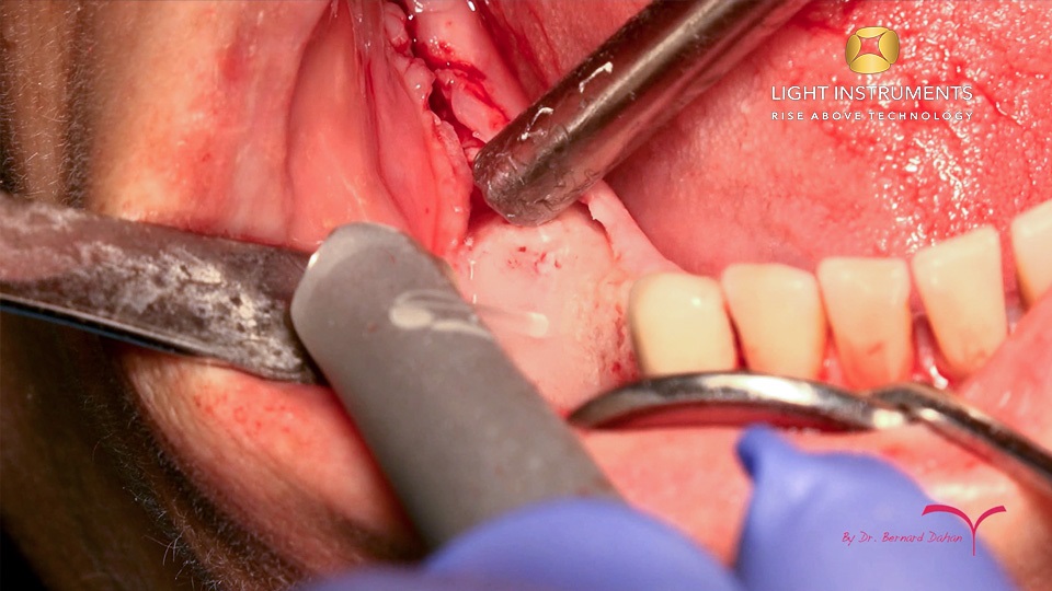 <strong> Decortication and dissection before implant placement with LiteTouch™ Er:YAG laser</strong>