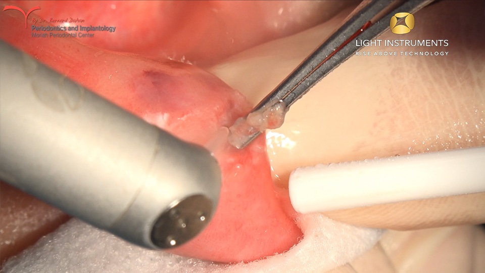 <strong>Polyp excision with LiteTouch™ Er:YAG laser</strong>