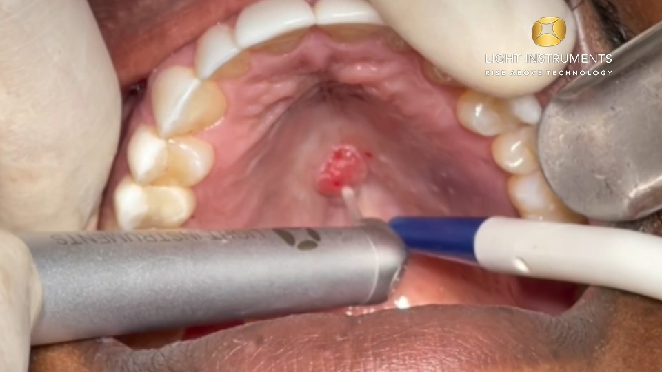 <strong>Treatment of oral lesion (no anesthesia) with LiteTouch™ Er:YAG laser</strong>