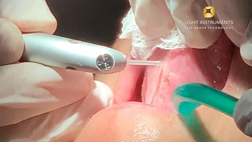<strong>Oral leukoplakia treatment on base of tongue with LiteTouch™ Er:YAG laser</strong>