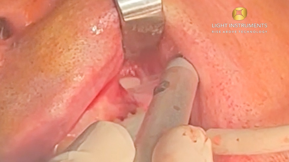 <strong>Window opening for sinus lift (very thick bone) with LiteTouch™ Er:YAG laser</strong>